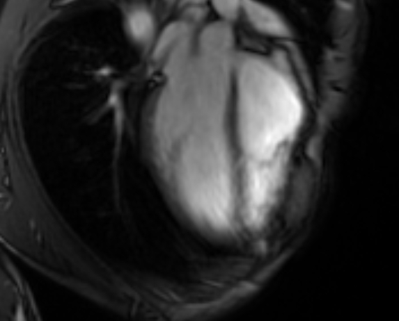 Arrhythmogenic right ventricular cardiomyopathy (Radiopaedia 69564-79464 4ch cine 36).jpg