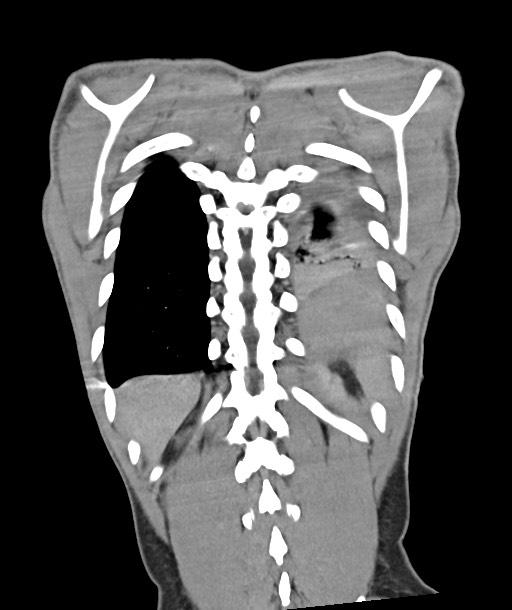 Arrow injury to the chest (Radiopaedia 85367-100975 F 108).jpg