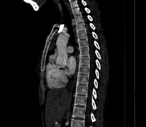 Arteria lusoria (Radiopaedia 88528-105192 C 50).jpg