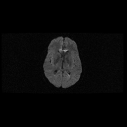 File:Arteriovenous malformation (cerebral) (Radiopaedia 40070-42580 Axial DWI 12).png