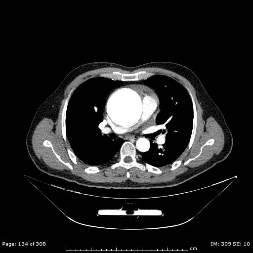 Ascending aortic aneurysm (Radiopaedia 50086-55404 A 36).jpg
