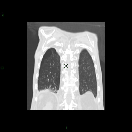 File:Aspergilloma (Radiopaedia 14842-14787 Coronal lung window 31).jpg
