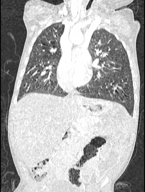 Asplenia syndrome (Radiopaedia 73083-83792 Coronal lung window 67).jpg