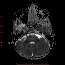 Astroblastoma (Radiopaedia 74287-85162 Axial ADC 10).jpg