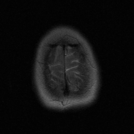 File:Astrocytoma - WHO grade II (Radiopaedia 16279-15959 Axial T2 2).jpg