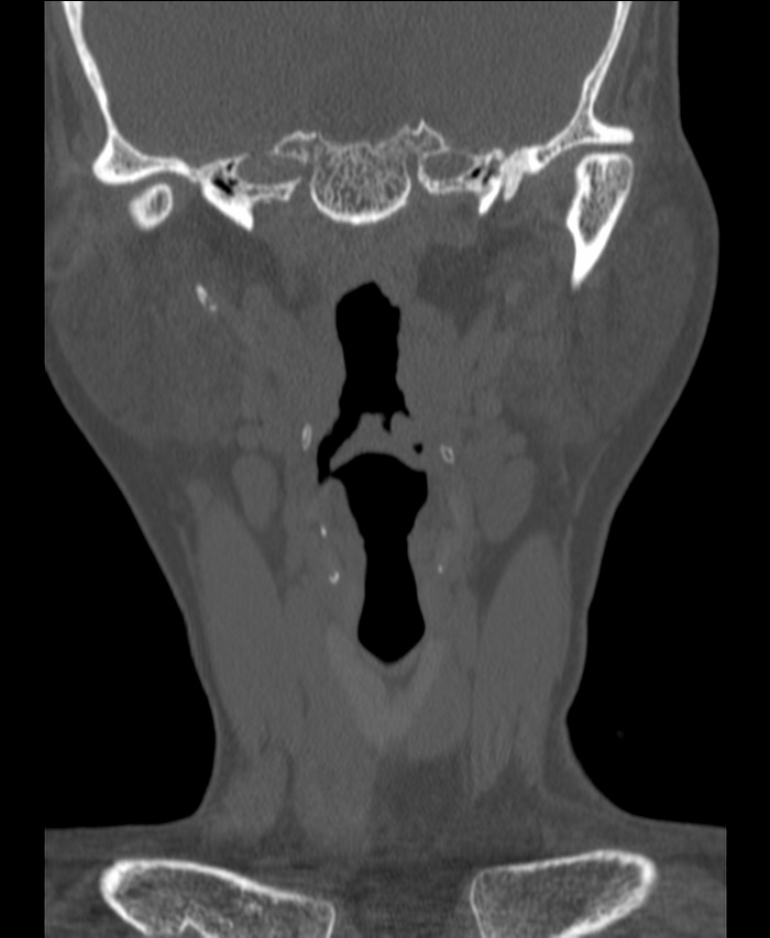 Atlanto-occipital assimilation with basilar invagination (Radiopaedia 70122-80188 Coronal bone window 13).jpg
