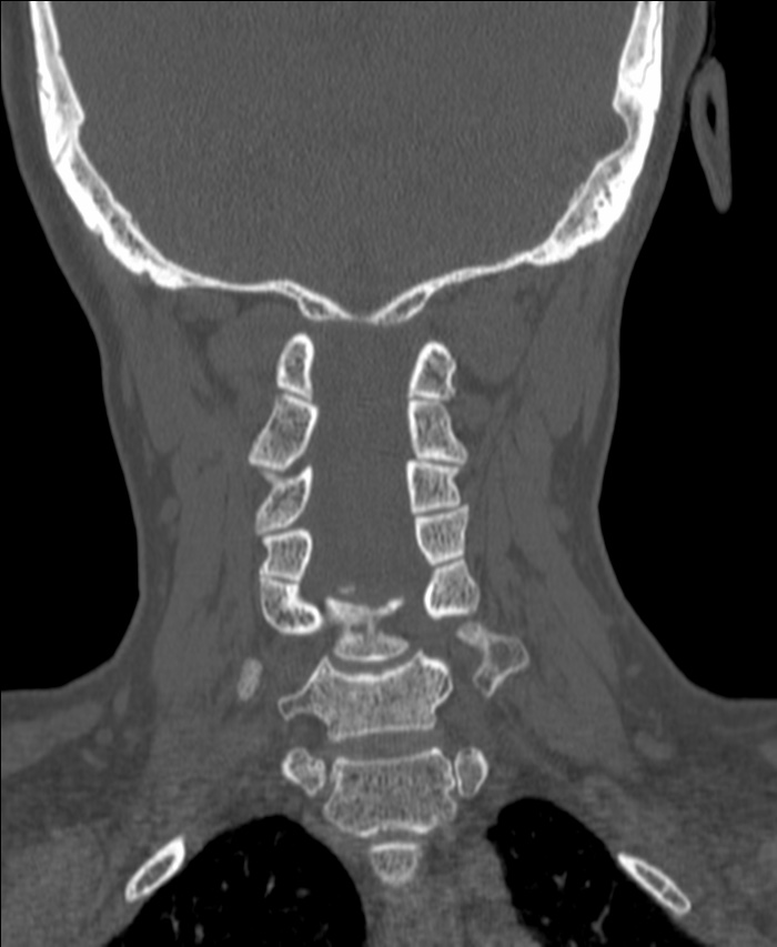 Atlanto-occipital assimilation with basilar invagination (Radiopaedia 70122-80188 Coronal bone window 136).jpg