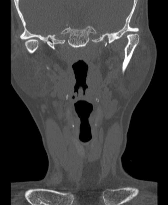 Atlanto-occipital assimilation with basilar invagination (Radiopaedia 70122-80188 Coronal bone window 8).jpg