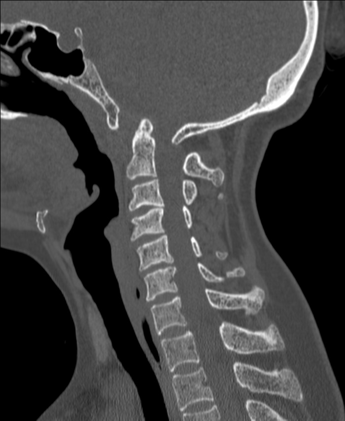 Atlanto-occipital assimilation with basilar invagination (Radiopaedia 70122-80188 Sagittal bone window 73).jpg