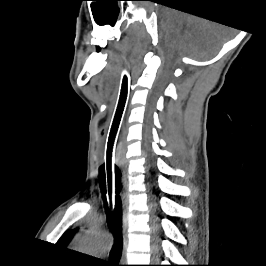 Atlanto-occipital dissociation (Traynelis type 1), C2 teardrop fracture, C6-7 facet joint dislocation (Radiopaedia 87655-104061 D 45).jpg