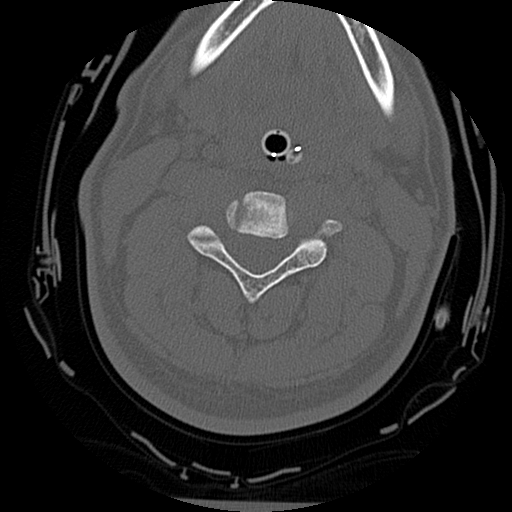 Atlanto-occipital dissociation injury (Radiopaedia 29274-29698 Axial bone window 34).png