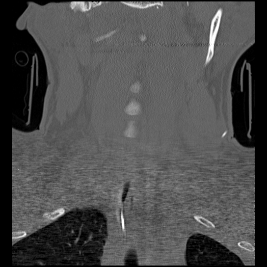 Atlanto-occipital dissociation injury (Radiopaedia 29274-29698 Coronal bone window 33).png