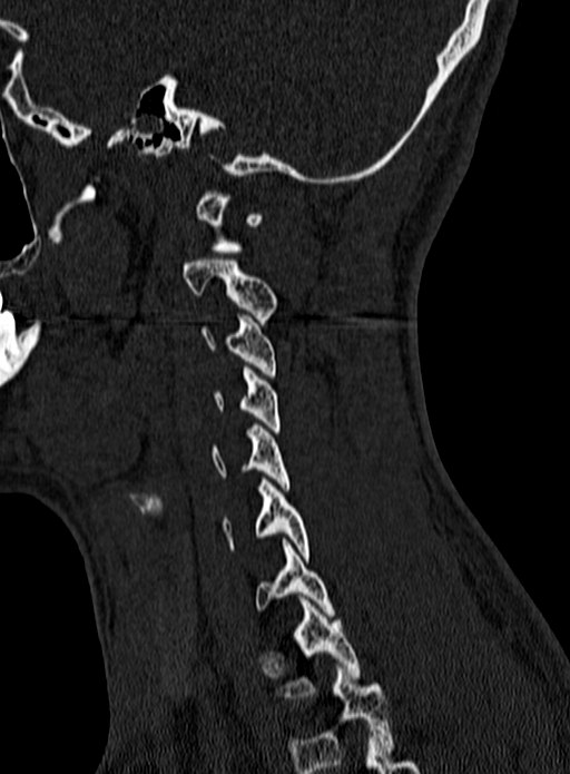Atlantoaxial subluxation (Radiopaedia 44681-48450 Sagittal bone window 136).jpg