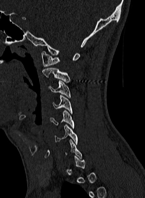 Atlantoaxial subluxation (Radiopaedia 44681-48450 Sagittal bone window 16).jpg