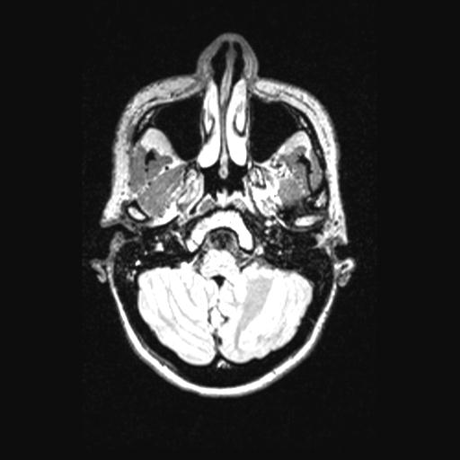 Atretic encephalocoele with inferior vermis hypoplasia (Radiopaedia 30443-31108 Axial 35).jpg