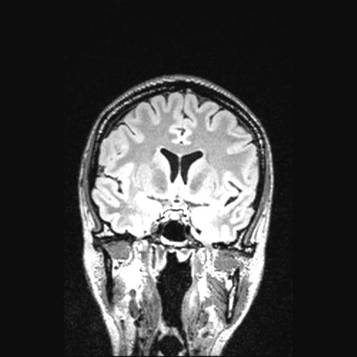 Atretic encephalocoele with inferior vermis hypoplasia (Radiopaedia 30443-31108 Coronal FLAIR 112).jpg