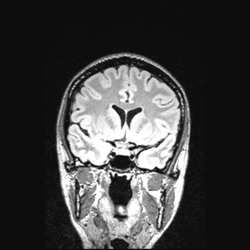 Atretic encephalocoele with inferior vermis hypoplasia (Radiopaedia 30443-31108 Coronal FLAIR 116).jpg