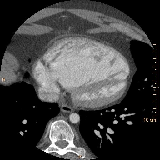File:Atrial septal defect (upper sinus venosus type) with partial anomalous pulmonary venous return into superior vena cava (Radiopaedia 73228-83961 A 210).jpg