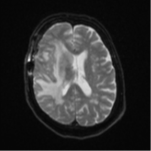 Atypical meningioma (WHO Grade II) (Radiopaedia 54742-60981 Axial DWI 17).png