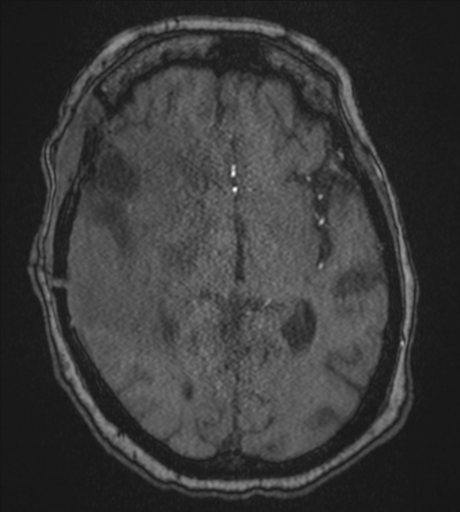 Atypical meningioma (WHO Grade II) (Radiopaedia 54742-60981 Axial MRA 47).png