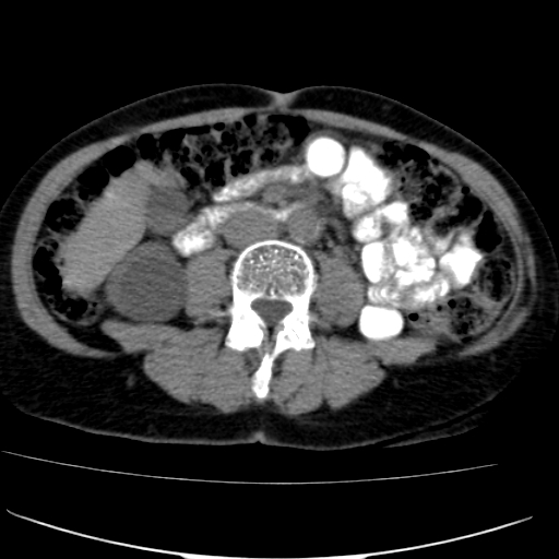 File:Atypical renal cyst (Radiopaedia 17536-17251 non-contrast 25).jpg