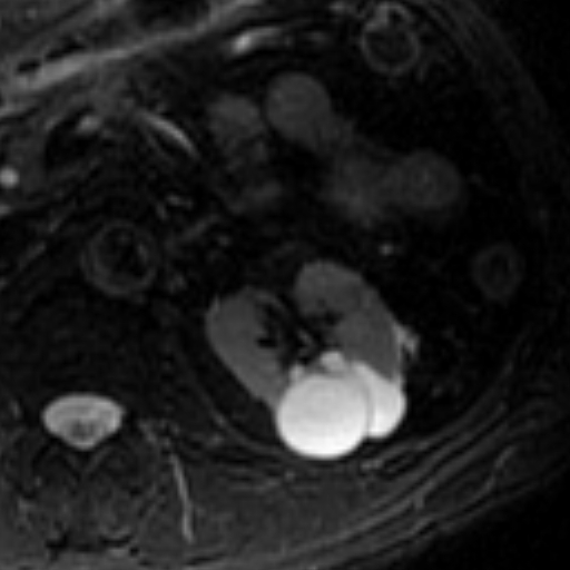 File:Atypical renal cyst on MRI (Radiopaedia 17349-17046 Axial T2 fat sat 9).jpg