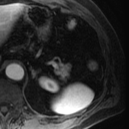 File:Atypical renal cyst on MRI (Radiopaedia 17349-17046 C 3).jpg