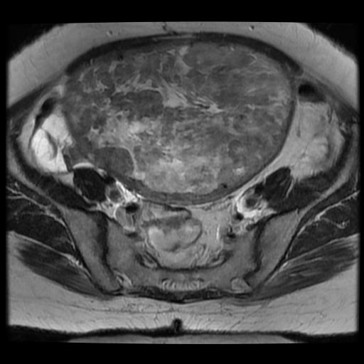 File:Atypical retroperitoneal lymphocoeles with large leiomyoma of uterus (Radiopaedia 32084-33027 Axial T2 16).jpg