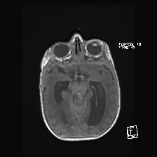 Atypical teratoid rhabdoid tumor (prenatal US and neonatal MRI) (Radiopaedia 59091-66388 Axial T1 25).jpg