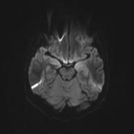 Autoimmune limbic encephalitis (Radiopaedia 30363-31005 Axial B0 and DWI 44).jpg