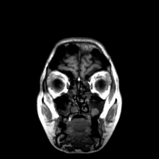 Autoimmune limbic encephalitis (Radiopaedia 30363-31005 Coronal T1 50).jpg