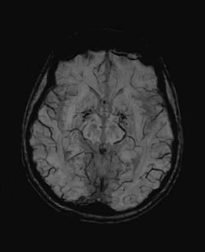 Autoimmune limbic encephalitis (Radiopaedia 30363-31005 SWI - mIP 32).jpg