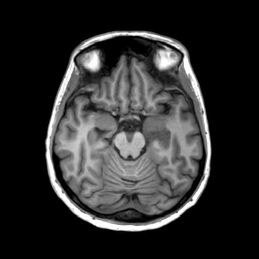 Autoimmune limbic encephalitis (Radiopaedia 30363-31005 T1 Axial 3mm 20).jpg