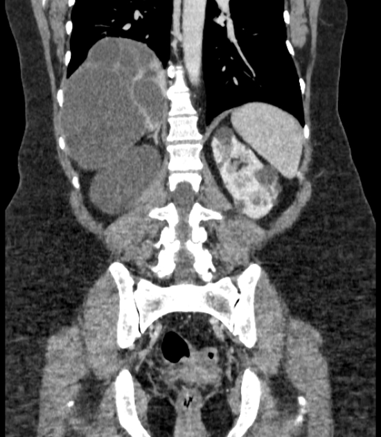 Autosomal dominant polycystic kidney disease (Radiopaedia 57124-64017 B 55).jpg