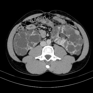 Autosomal dominant polycystic kidney disease (Radiopaedia 66349-75582 B 57).jpg