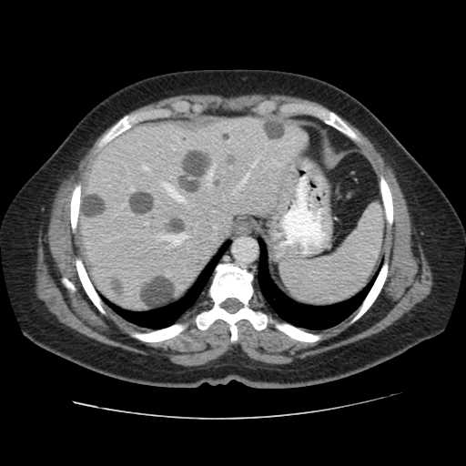 Autosomal dominant polycystic kidney disease with hepatic involvement (Radiopaedia 32693-33662 B 11).jpg