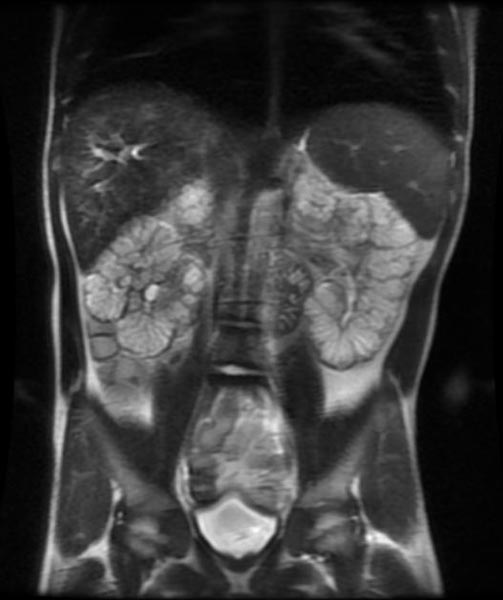 File:Autosomal recessive polycystic kidney disease (Radiopaedia 11224-11589 Coronal T2 1).jpg