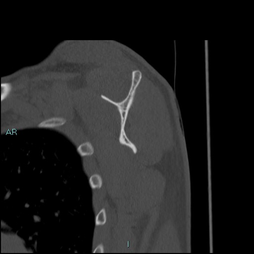 Avascular necrosis after fracture dislocations of the proximal humerus (Radiopaedia 88078-104653 Sagittal bone window 50).jpg