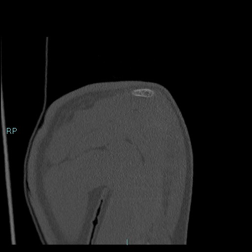 Avascular necrosis after fracture dislocations of the proximal humerus (Radiopaedia 88078-104655 Coronal bone window 44).jpg