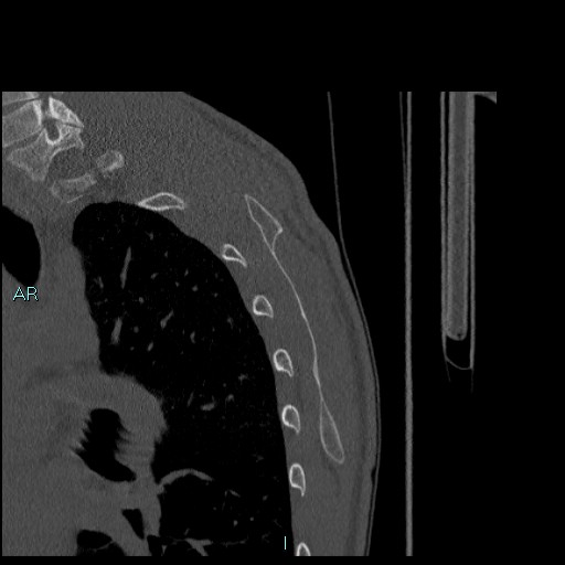 Avascular necrosis after fracture dislocations of the proximal humerus (Radiopaedia 88078-104655 Sagittal bone window 80).jpg
