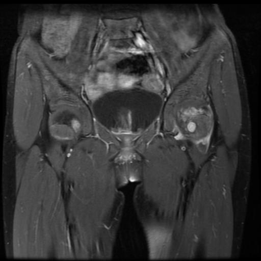 File:Avascular necrosis of the hip (Radiopaedia 29563-30067 I 5).jpg