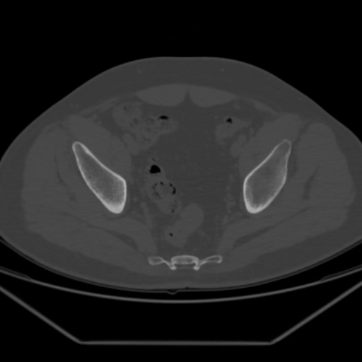 File:Avascular necrosis of the hip (Radiopaedia 61503-69467 Axial bone window 21).jpg