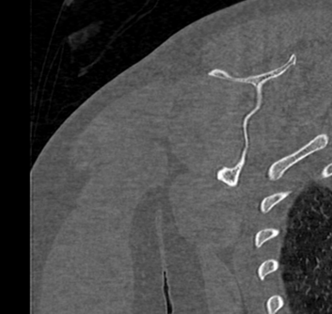 Avulsion fracture - greater tuberosity of humerus (Radiopaedia 71216-81514 Coronal bone window 67).jpg