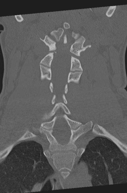 Axis peg fracture (type 3) and atlas lateral mass (type 4) fracture (Radiopaedia 37474-39324 Coronal bone window 25).png