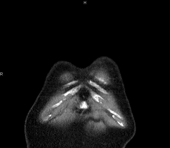 Azygos continuation of the inferior vena cava (Radiopaedia 18537-18404 B 3).jpg
