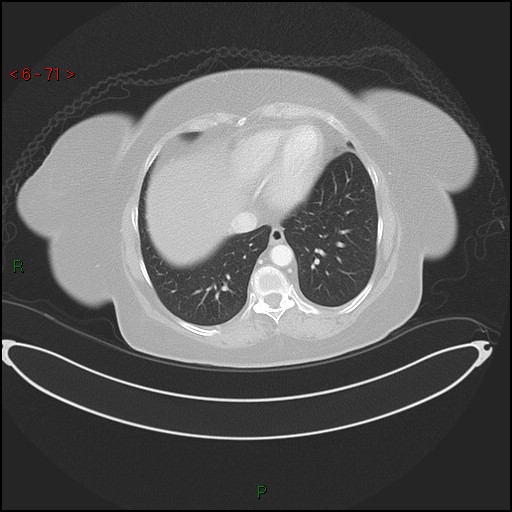 File:Azygos fissure and lobe (Radiopaedia 47620-52278 Axial lung window 71).jpg