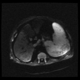 B cell lymphoma (Radiopaedia 56281-62954 Axial DWI 18).jpg