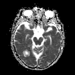 File:Balo concentric sclerosis (Radiopaedia 53875-59982 Axial ADC 10).jpg