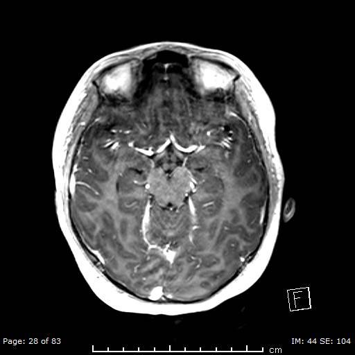 Balo concentric sclerosis (Radiopaedia 61637-69636 Axial T1 C+ 28).jpg