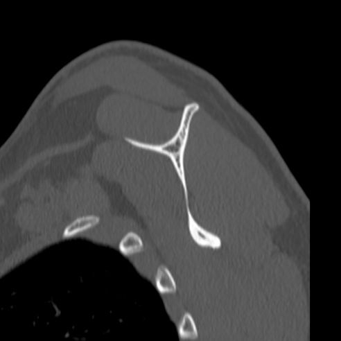 Bankart lesion (Radiopaedia 57256-64185 Sagittal bone window 45).jpg